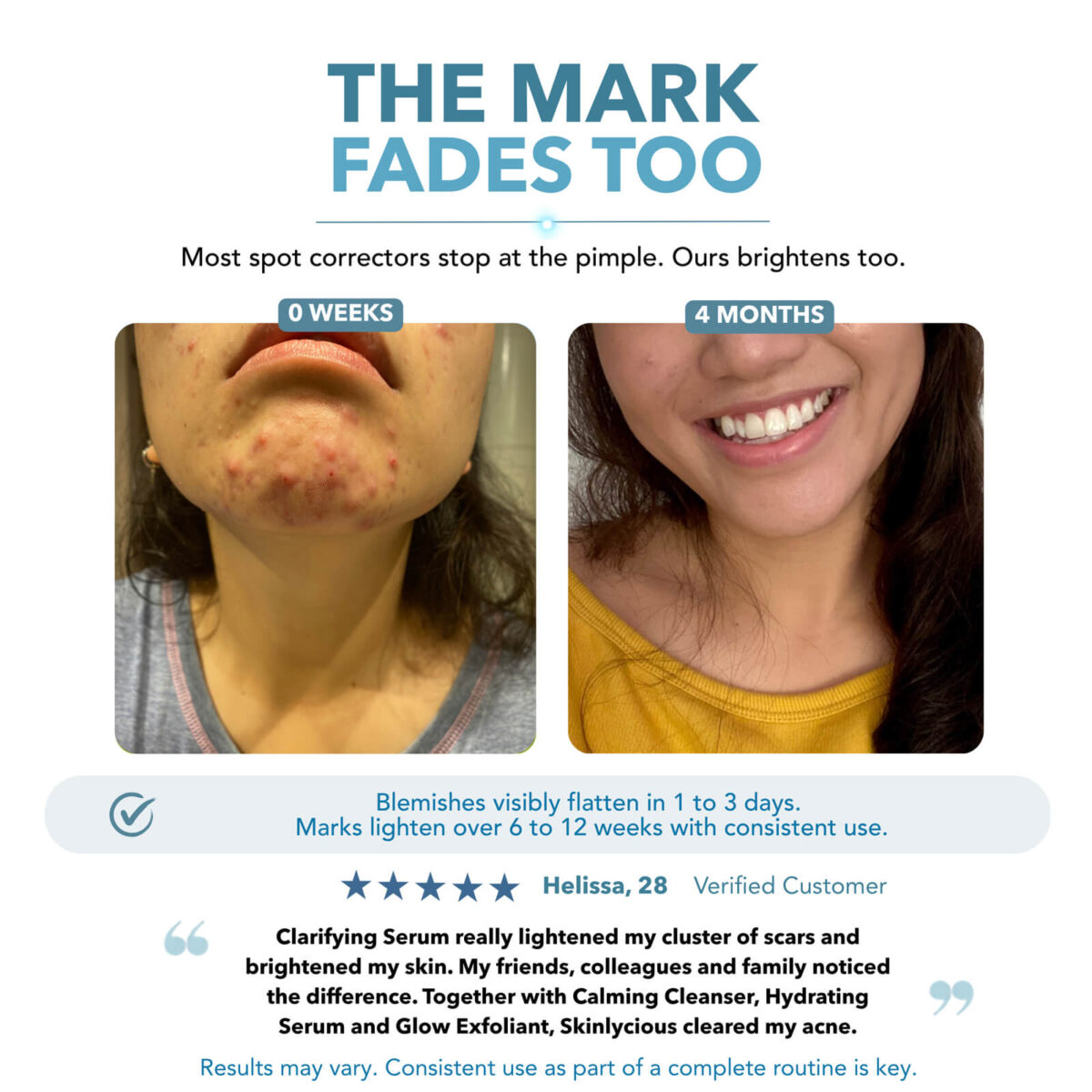 Before and after skin results showing pimples and post-acne marks after four months of a Skinlycious skincare routine
