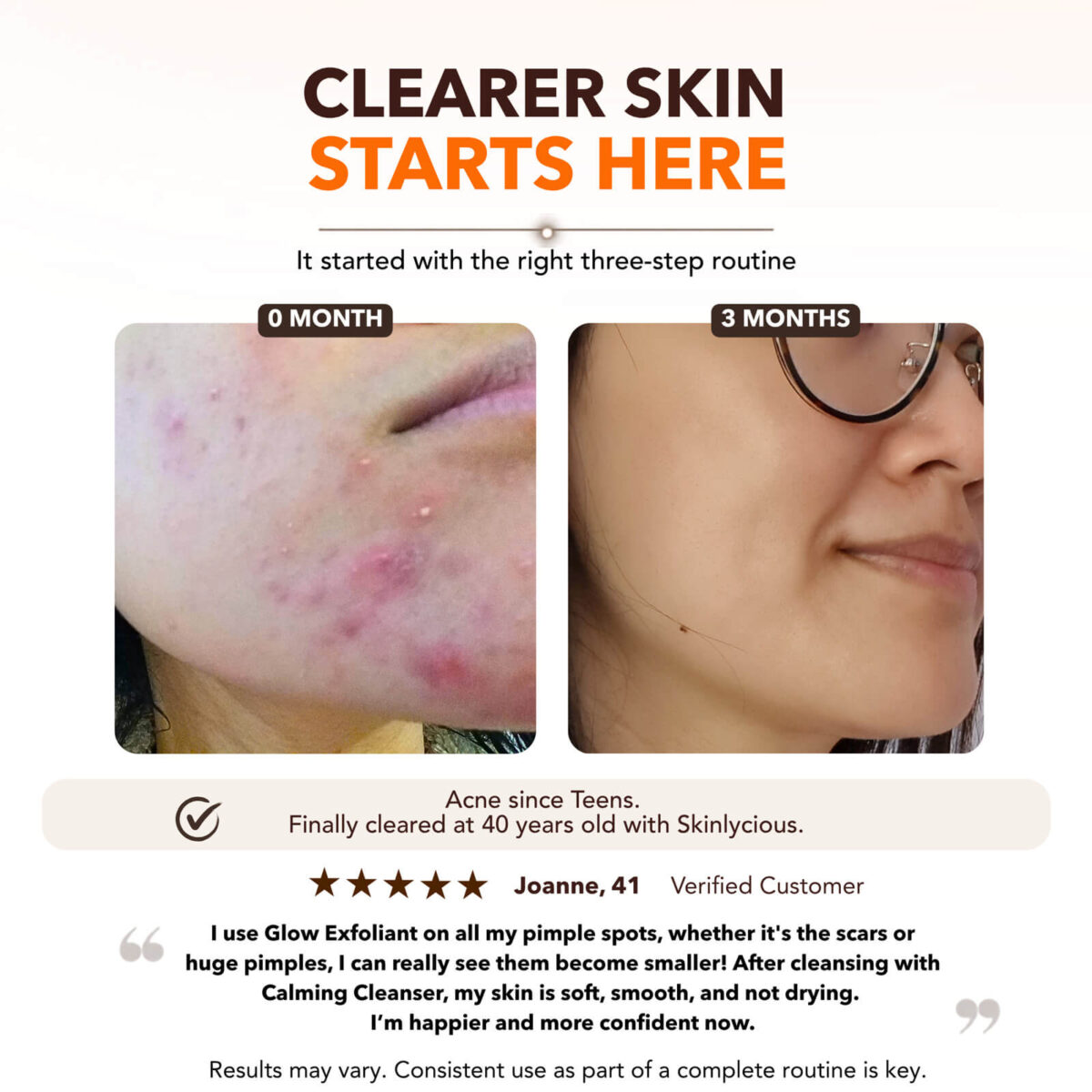 Skinlycious customer before-and-after photos showing changes in acne-prone skin over three months, alongside a customer testimonial.
