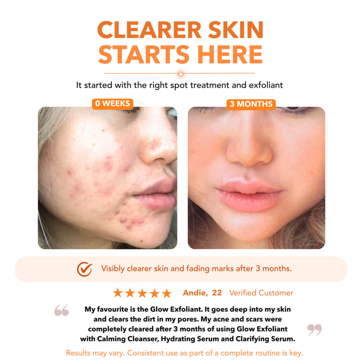 Before and after skin results showing clearer skin and fading acne marks after three months of a Skinlycious skincare