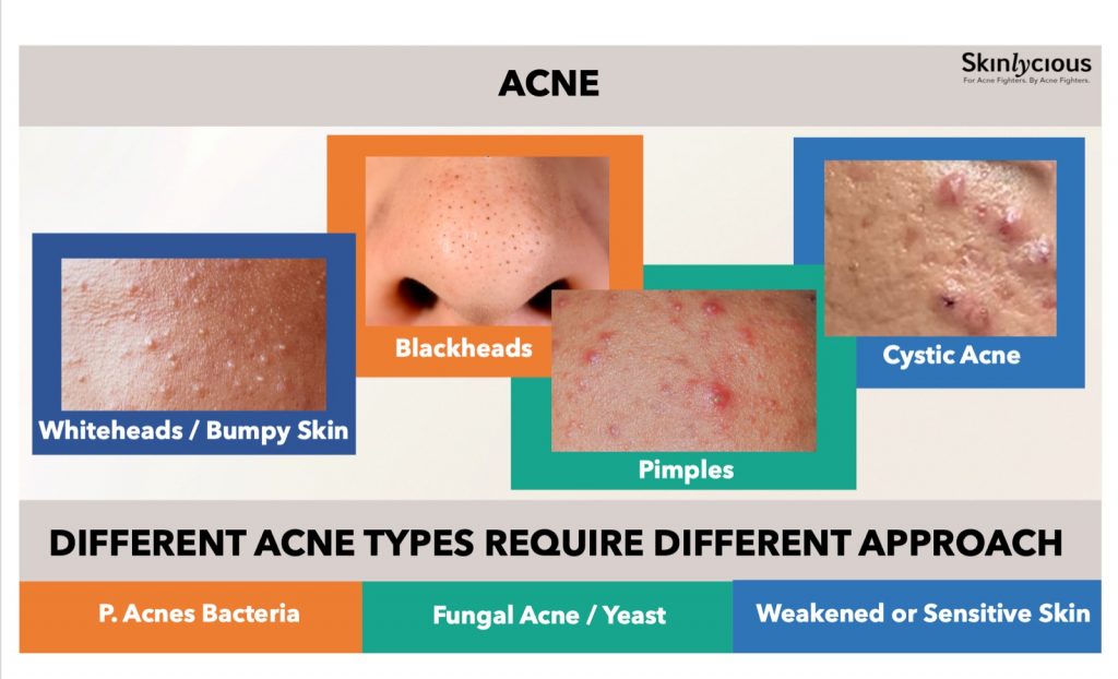 What is Fungal acne? Skinlycious AntiAcne Skincare by Acne Fighters