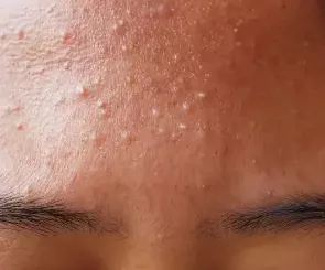 Allergic Breakouts vs Purging