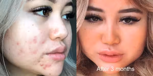 Skinlycious result 06