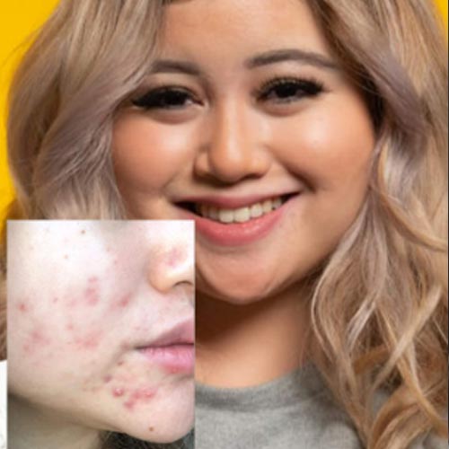 The acne veteran