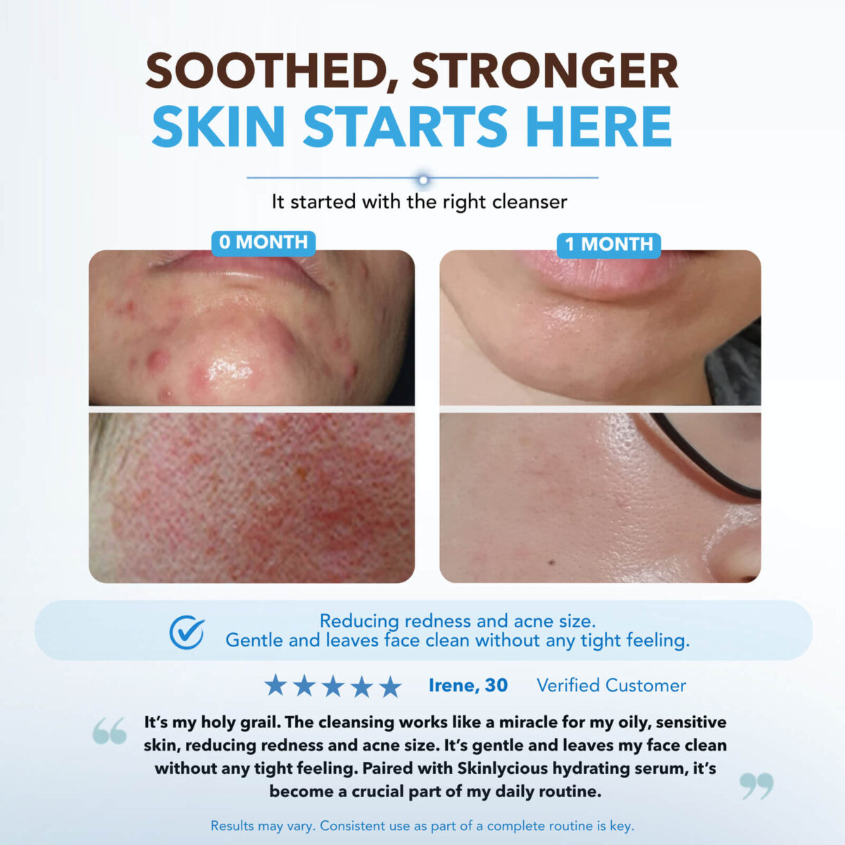 Customer results after using Skinlycious Soothing Cleansing Gel, showing improvement in the appearance of redness and acne-prone skin after one month.