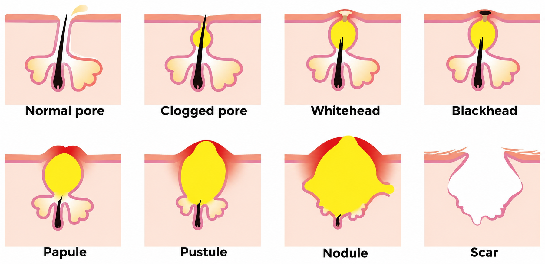 Types of Acne in Diagrammatic Form