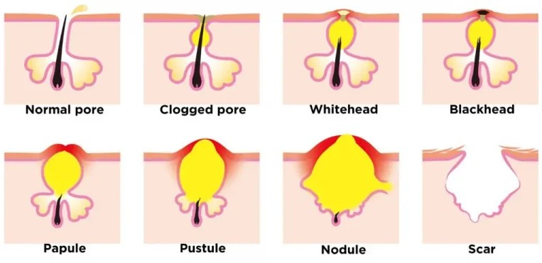 Types of Acne in Diagrammatic Form