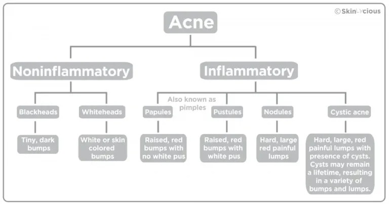 Types of Acne in Word Form