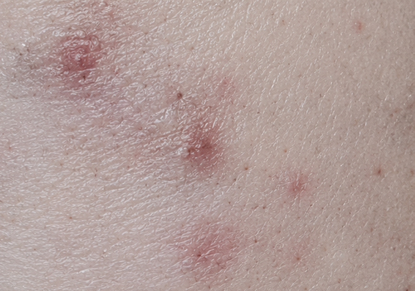Red/Brown/Purple “Scars”