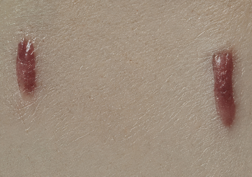Hypertrophic and Keloidal – Raised Acne Scars