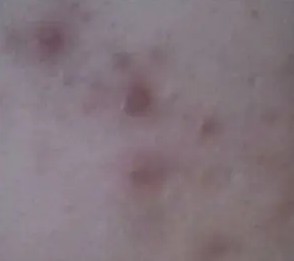 Red/Brown/Purple “Scars”