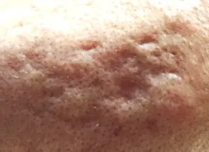 Atrophic – Pitted, Depressed Scars