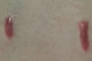 Hypertrophic and Keloidal – Raised Acne Scars