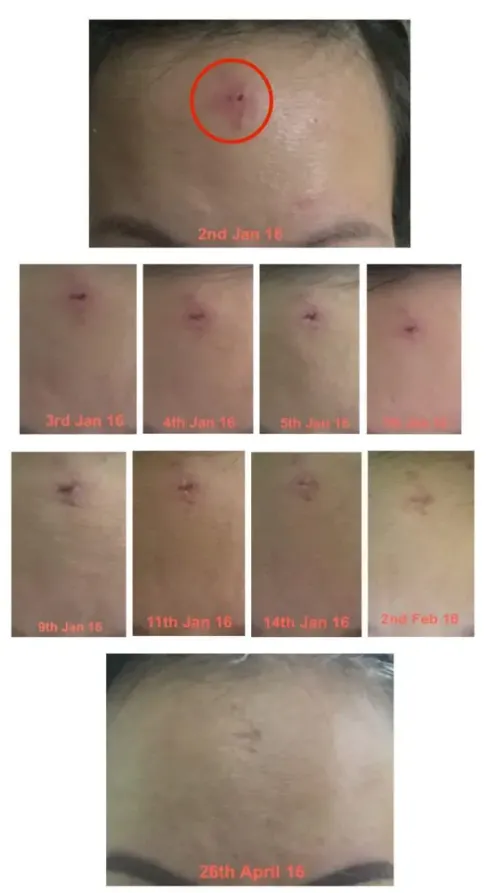 Cystic Acne