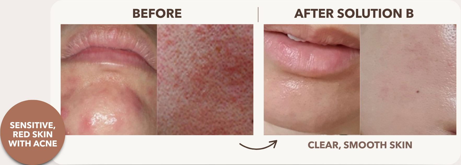 7 Botanical Extracts at the Concentration That Cleared Irene’s Skin