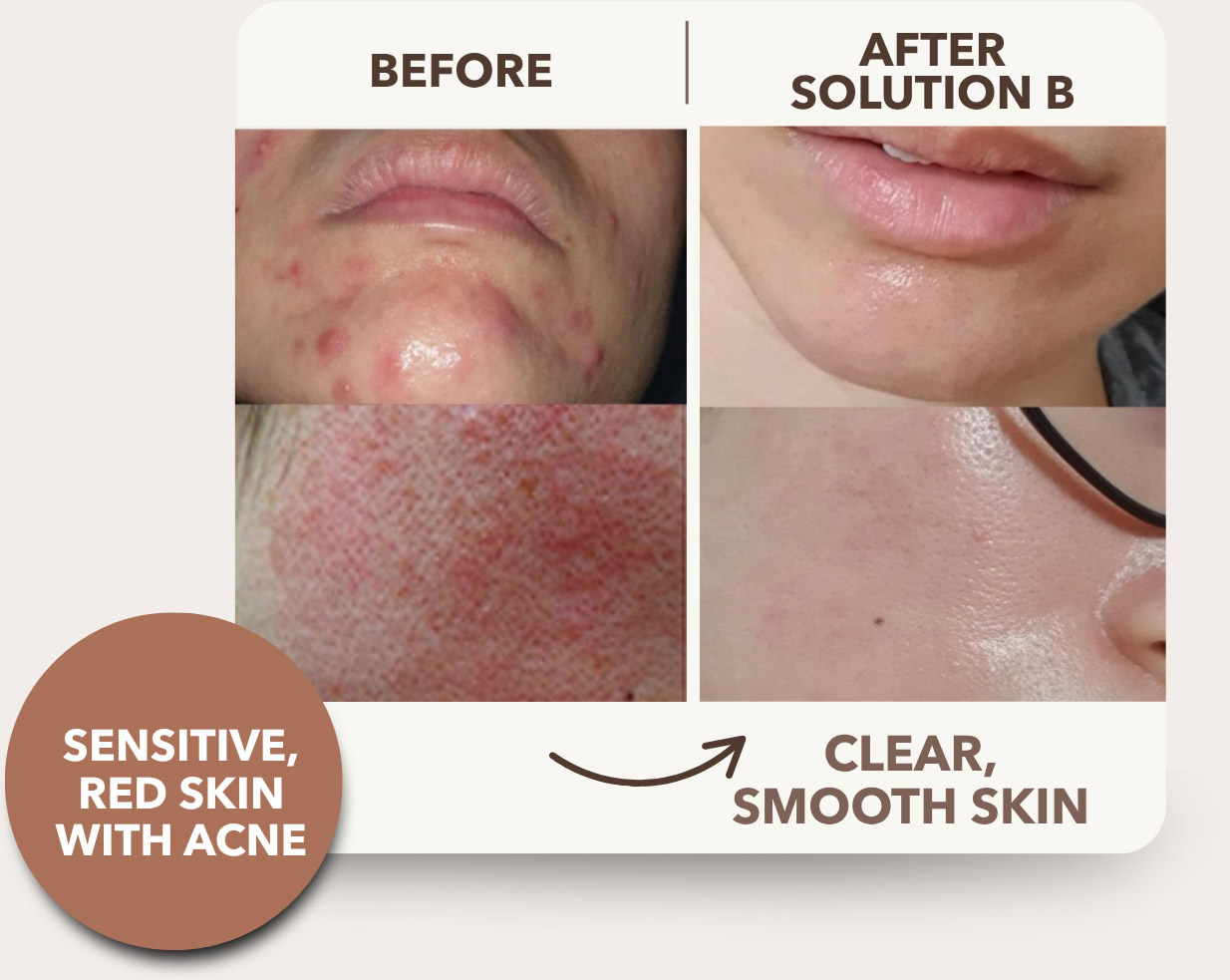 7 Botanical Extracts at the Concentration That Cleared Irene’s Skin