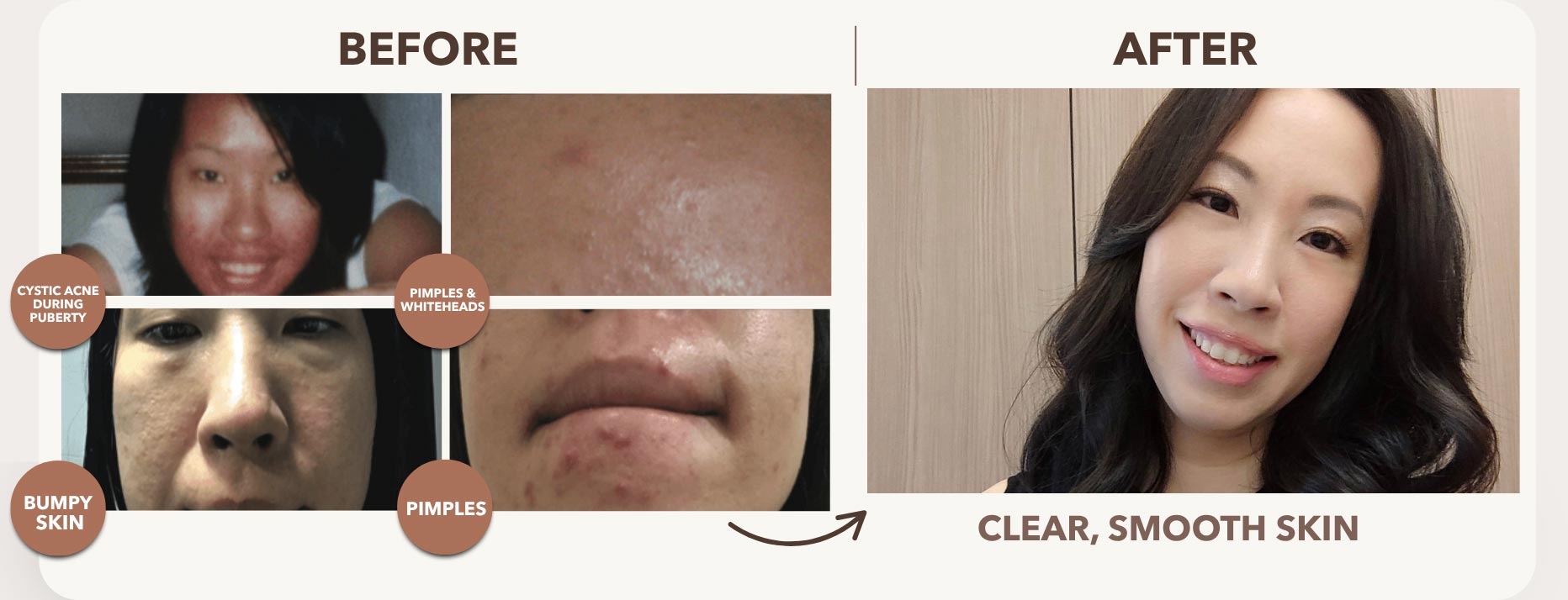 Crafted By Real Acne Fighters — For Real Acne Fighters
