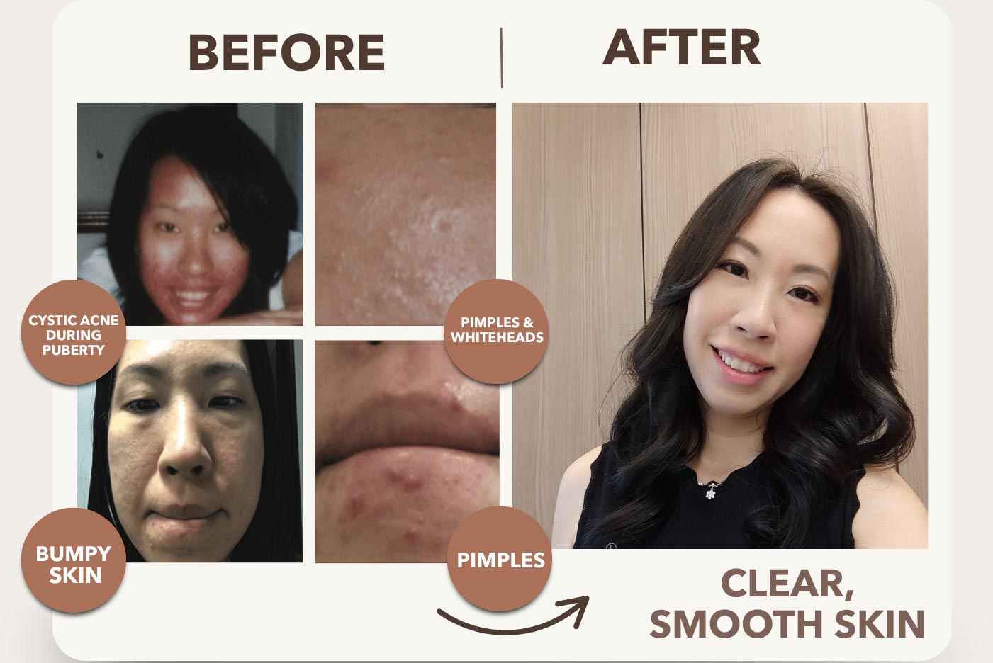 Crafted By Real Acne Fighters — For Real Acne Fighters