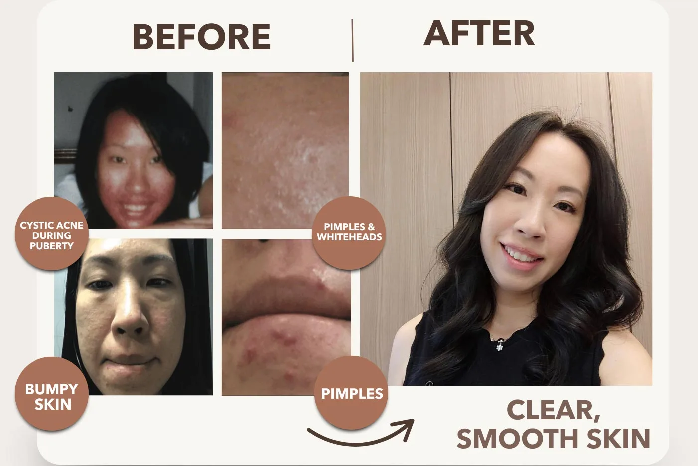 Crafted By Real Acne Fighters — For Real Acne Fighters