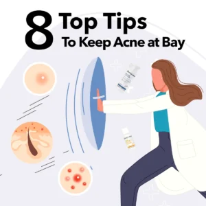 8 top tips to keep acne at bay