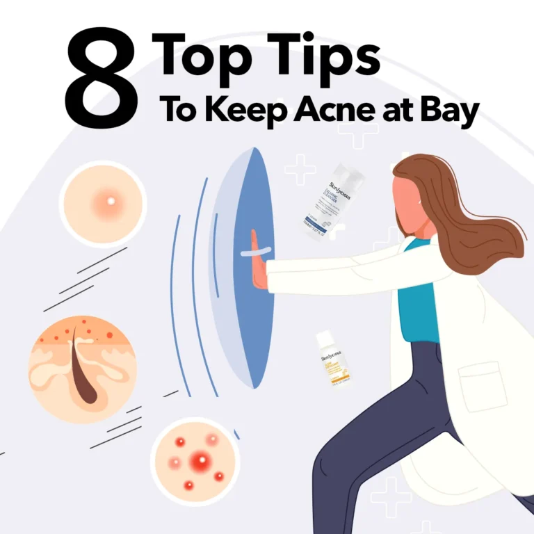 8 top tips to keep acne at bay