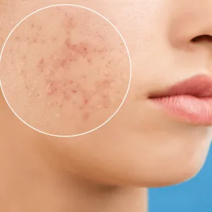 Be Self Aware Of Your Own Acne Triggers