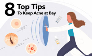 Top 8 Tips To Keep Acne At Bay