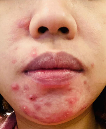 2 Proven Paths to Clear Skin 13