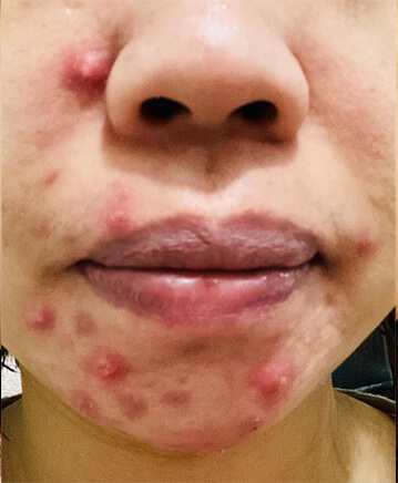 2 Proven Paths to Clear Skin 12