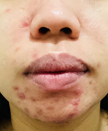 2 Proven Paths to Clear Skin 11