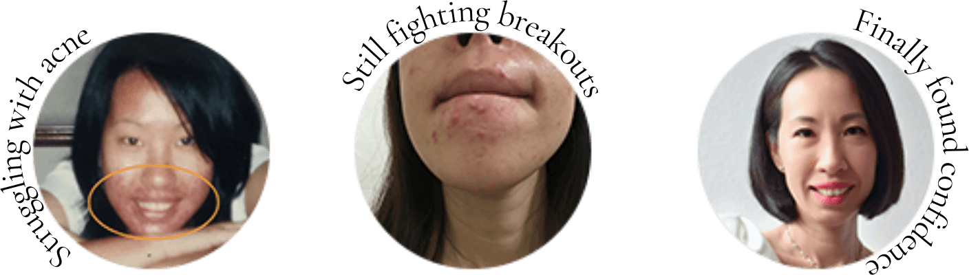 From 14 Years of Struggle to Your Clear Skin Solution