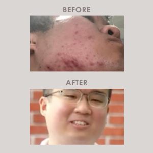 The acne veteran