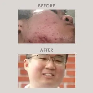 The acne veteran