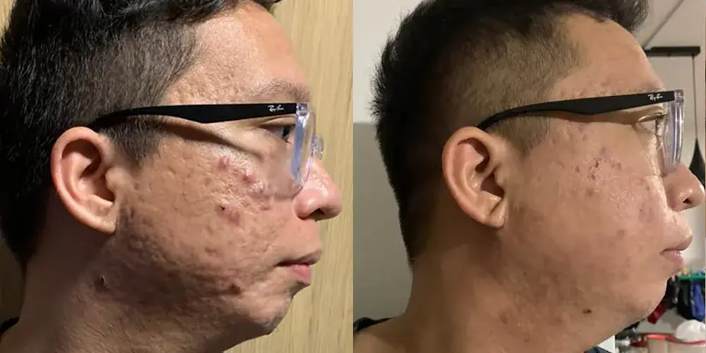 Skinlycious result 04