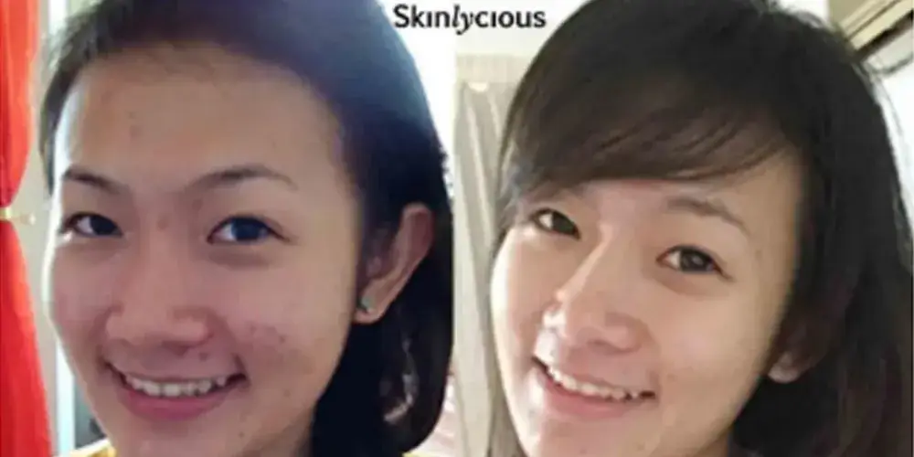 Skinlycious result 09