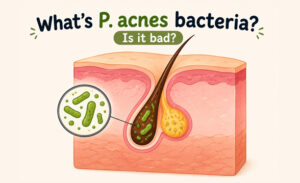 What’s P. acnes bacteria? Is it bad?
