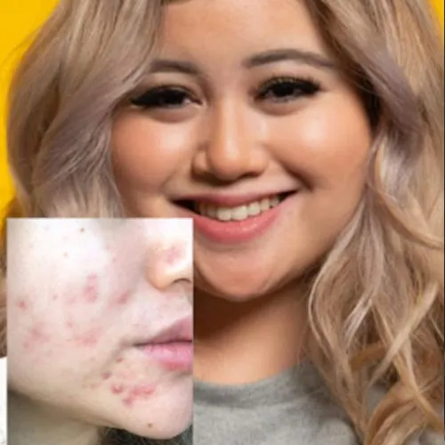 The acne veteran